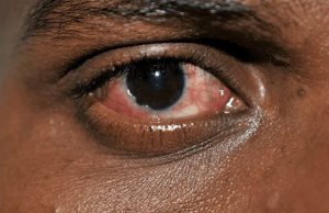 What to do when red eye disease strikes
